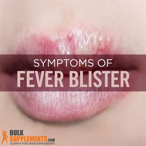 Blisters On Lips Due To Fever