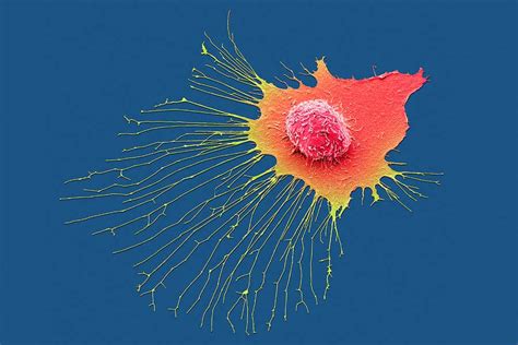 Breast Cancer Spreads Through The Body In Just Two Or Three Waves New