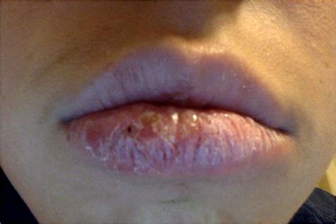Actinic Prurigo Cheilitis With Lower Vermilion Lip Edema Erosions And