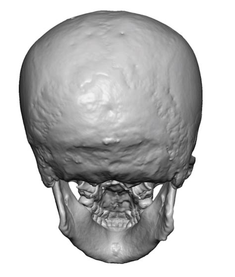 Plastic Surgery Case Study Custom Skull Implant For Right Flat Back