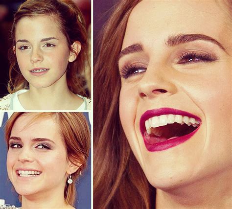 Emma Watson Teeth Before And After Hoyt Dental Murrieta And Temecula