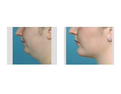 Neck Liposuction With Chin Implant Dr Barry Eppley Indianapolis
