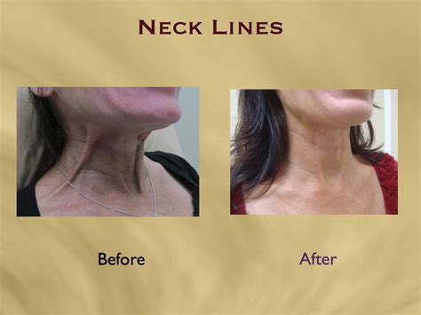 Nefertiti Lift And Neck Wrinkle Smoothing With Botox Aesthetics Hawaii