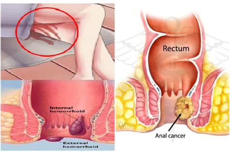 Colon cancer can result in iron deficiency anemia through blood loss during bowel movements and reduced gut absorption of dietary sources of iron. 6 Warning Signs of Anal Cancer Nobody Want To Talk About