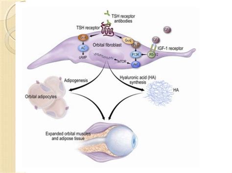 Thyroid Eye Disease