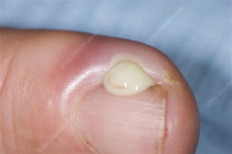 Paronychia Infection Of The Finger Stock Image C0090030 Science