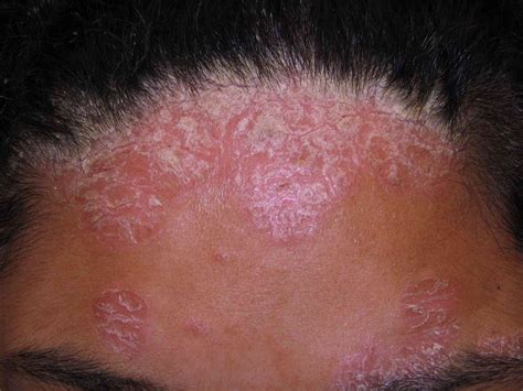 The Connection Between Ibd And Psoriasis