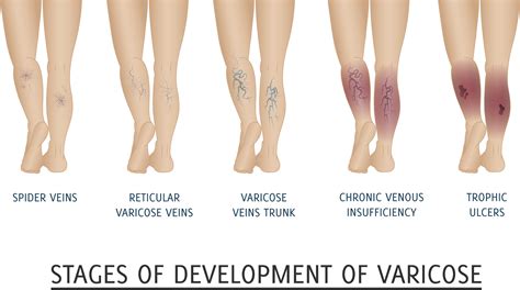 Everything You Need To Know About Venous Ulcers Vein Centre