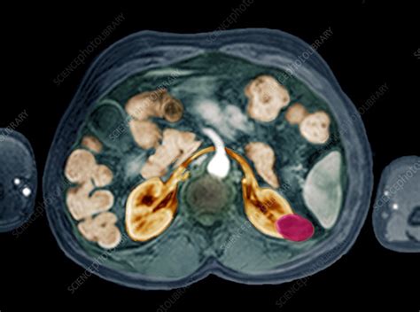Cancer Of The Kidney Mri Scan Stock Image C0037272 Science