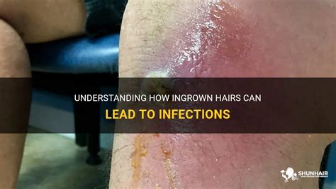 Understanding How Ingrown Hairs Can Lead To Infections Shunhair