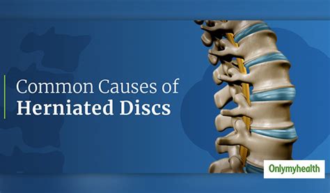 What Is A Slipped Disc Here Are Its Signs Causes Treatment And