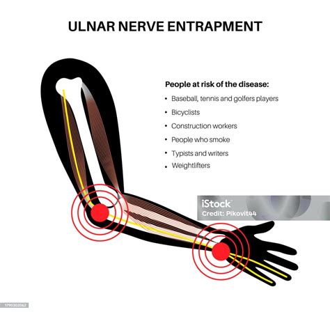 Ulnar Nerve Entrapment Stock Illustration Download Image Now