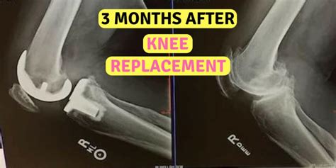 3 Months After Knee Replacement Surgery Pain And Progress