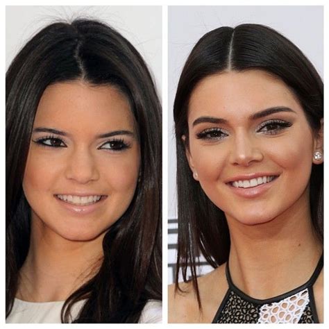 Kylie And Kendall Jenner Before And After