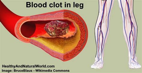 Ones who do experience leg pain due to thigh blood clot, may find it gradually worsen over time. Blood Clot in Leg: Signs, Symptoms, and Treatment ...
