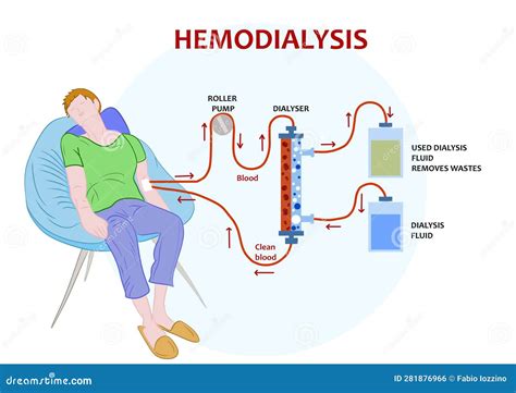 Infographic Of Hemodialysis A Procedure Where A Dialysis Machine Are