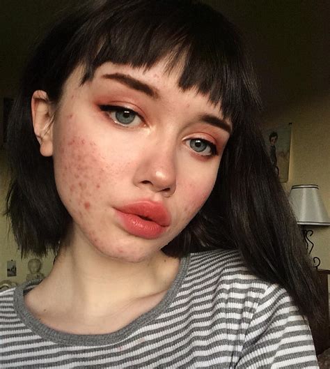 Teen Shares Viral Acne Message On Instagram Teen Vogue