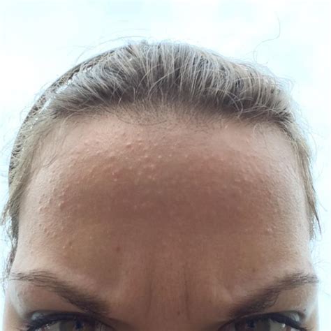 Small Flesh Colored Bumps On Forehead And Hairline Adult Acne