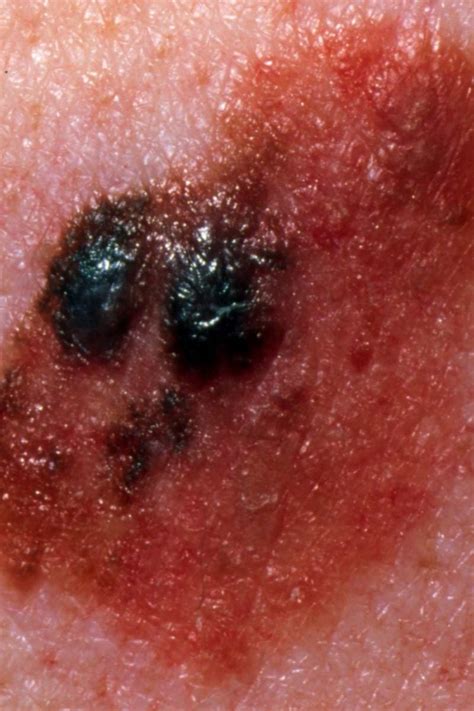 Stage 4 Melanoma Survival Rate Pictures And Treatment