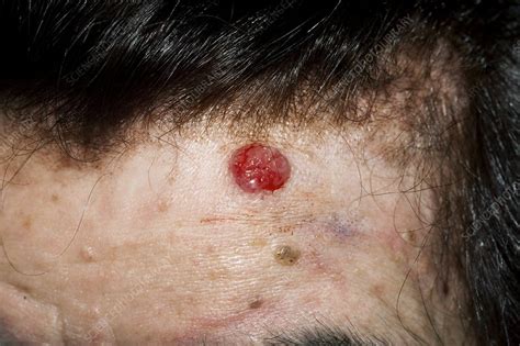 Basal Cell Skin Cancer On The Forehead Stock Image C0103364