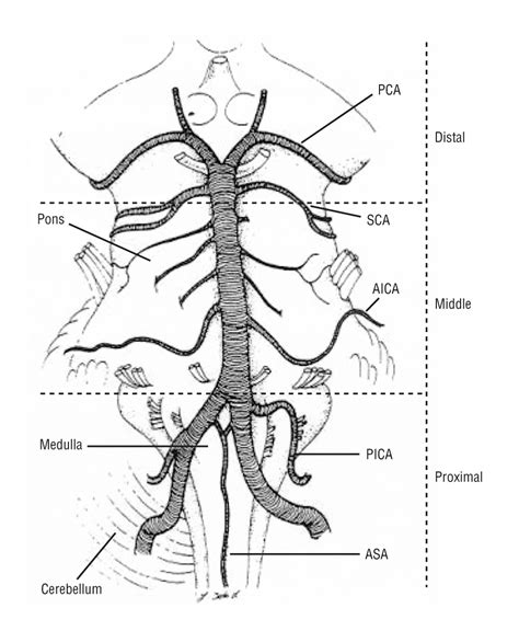 Basilar Artery Occlusive Disease In The New England Medical Center