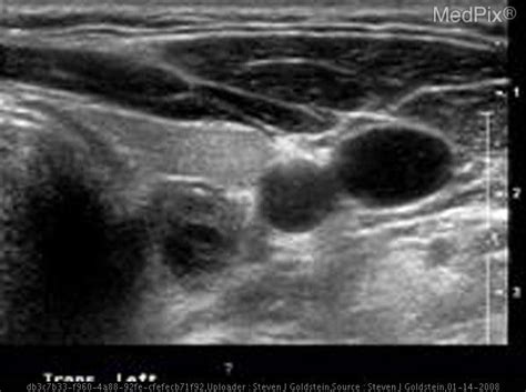 Parathyroid Tumor Ultrasound