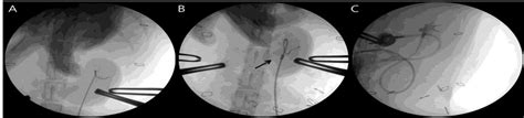 Fluoroscopic Guided Placement Of Nephrostomy Catheter A C Proper