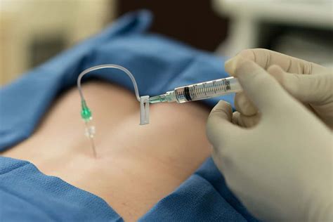 Epidural Steroid Injections What To Expect Core Medical Wellness
