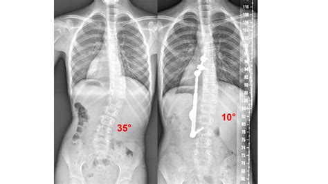 Degree Scoliosis Cervical Curve