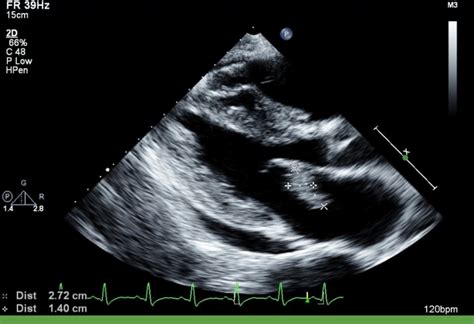 Parasternal Long Axis View Of Transthoracic Echocardiography 27×14