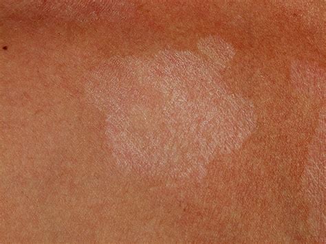 Pityriasis versicolor is not dangerous or contagious but causes cosmetic concerns in pityriasis alba. dermatoweb.net