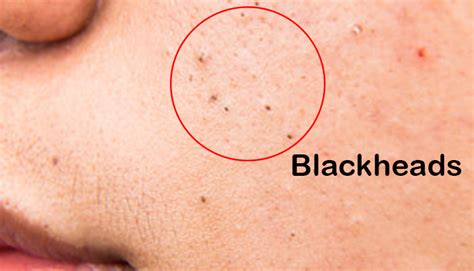 How To Remove The Blackheads Effectively Savedelete