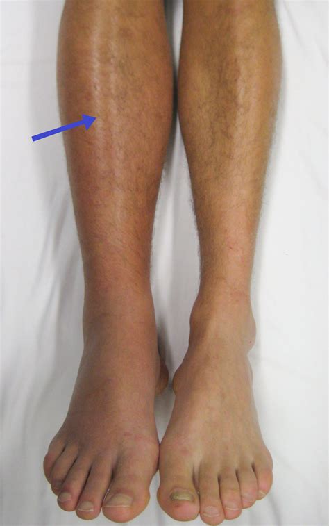 Filedeep Vein Thrombosis Of The Right Leg