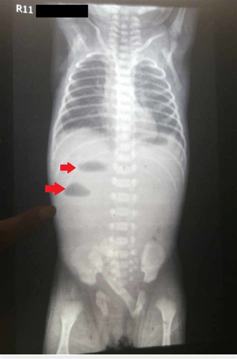 X Ray Abdomen Showing Two Air Fluid Levels In The Left Hypochondrium