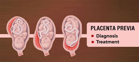 Placenta Previa What Is It And What To Do Medplusmart