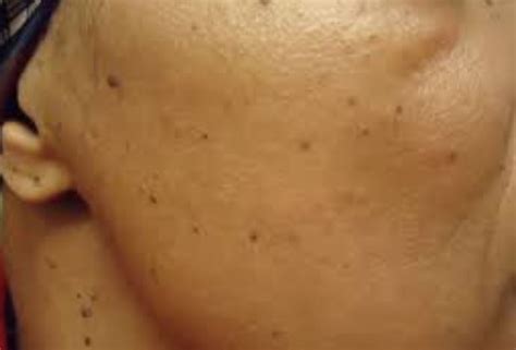 Dark Spots On Skin Causes And Best Removal Ways Skincarederm