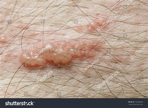 Raised Red Bumps Blisters Caused By库存照片102968996 Shutterstock