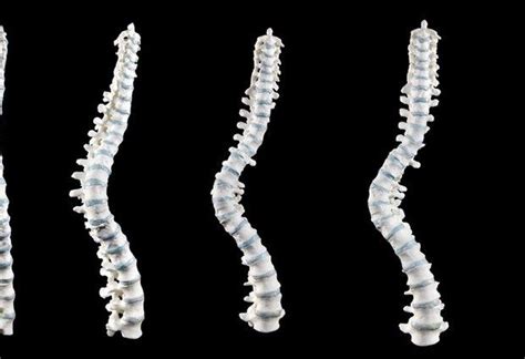 3d Spine Print Reveals Richard Iii Had Scoliosis Not A Hunched Back