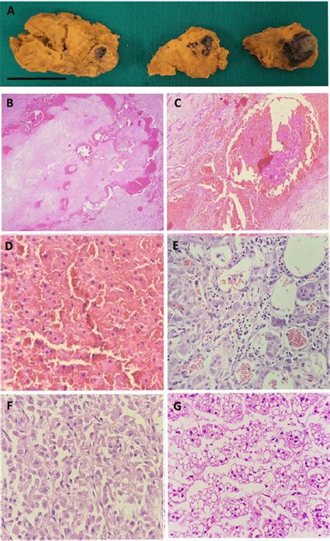 Adrenal Pathology Autopsy Findings In Five Severe Covid 19 Patients