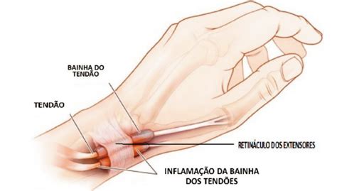 Tendinite tudo que você precisa saber