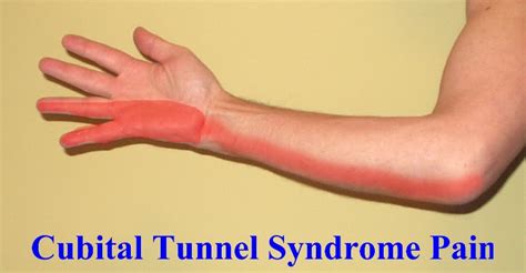 Cubital Tunnel Syndrome