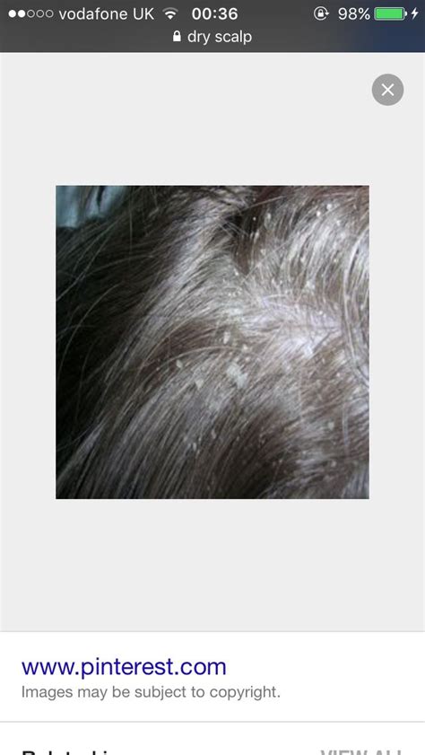 Dry Scalp Causes Symptoms Treatment Emedihealth