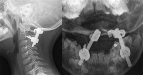 Bilateral C1 Laminar Hooks Combined With C2 Pedicle Screw Fixation In