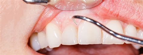 Wei Es Zahnfleisch Symptome Ursachen Und Behandlung