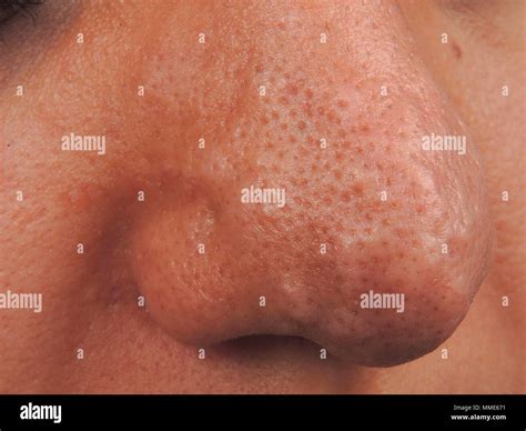 Sweat Gland High Resolution Stock Photography And Images Alamy