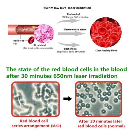 Laser Blood Irradiation Device For High Blood Pressure Physio Therapy