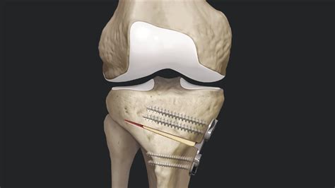 Arthrex High Tibial Osteotomy Using Tibial Opening Wedge Osteotomy Plates