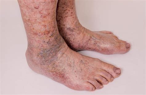 Op Ration Maladroit Atlas Brown Skin Discoloration On Lower Legs Agneau