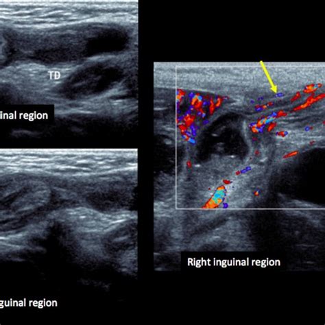 Palpable Nonreducible Cystic Mass In The Inguinal Region Located