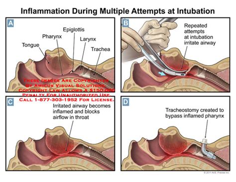 Amicus Illustration Of Amicusinjurythroatinflammationattempts